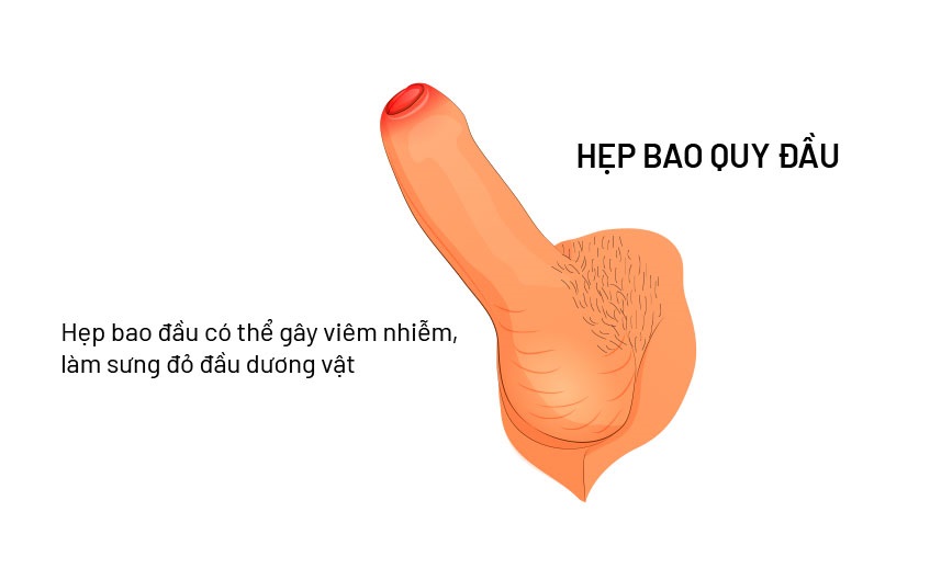 Chữa hẹp bao quy đầu tại Hải Phòng