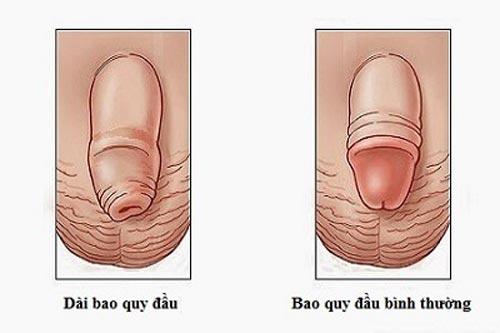 Bao quy đầu dài có nên cắt không Hải Phòng