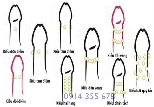 Gắn bi thẩm mỹ cho nam giới tại Hải Phòng