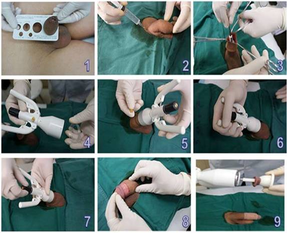 Giá cắt bao quy đầu cho nam giới tại Hải Phòng