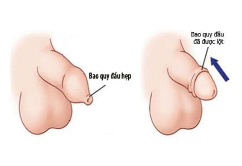Dấu hiệu hẹp bao quy đầu tại Hải Phòng