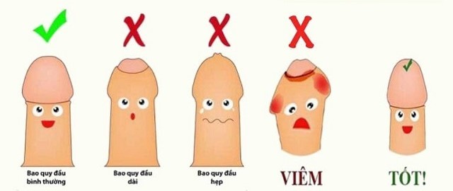 Cắt bao quy đầu tại Hải Phòng